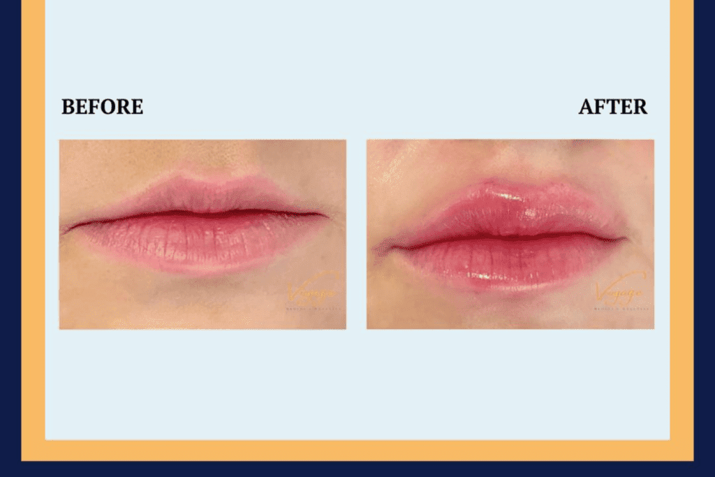 before and after picture of lips 
lip fillers near me st petersburg