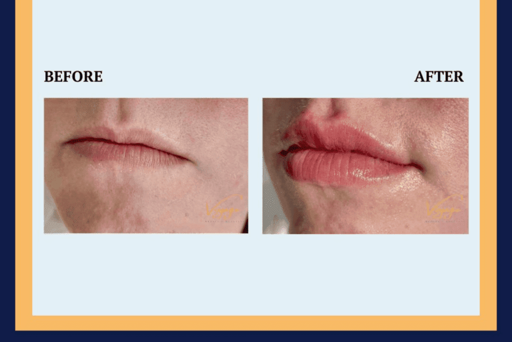 before and after lips filler near me st pete fl