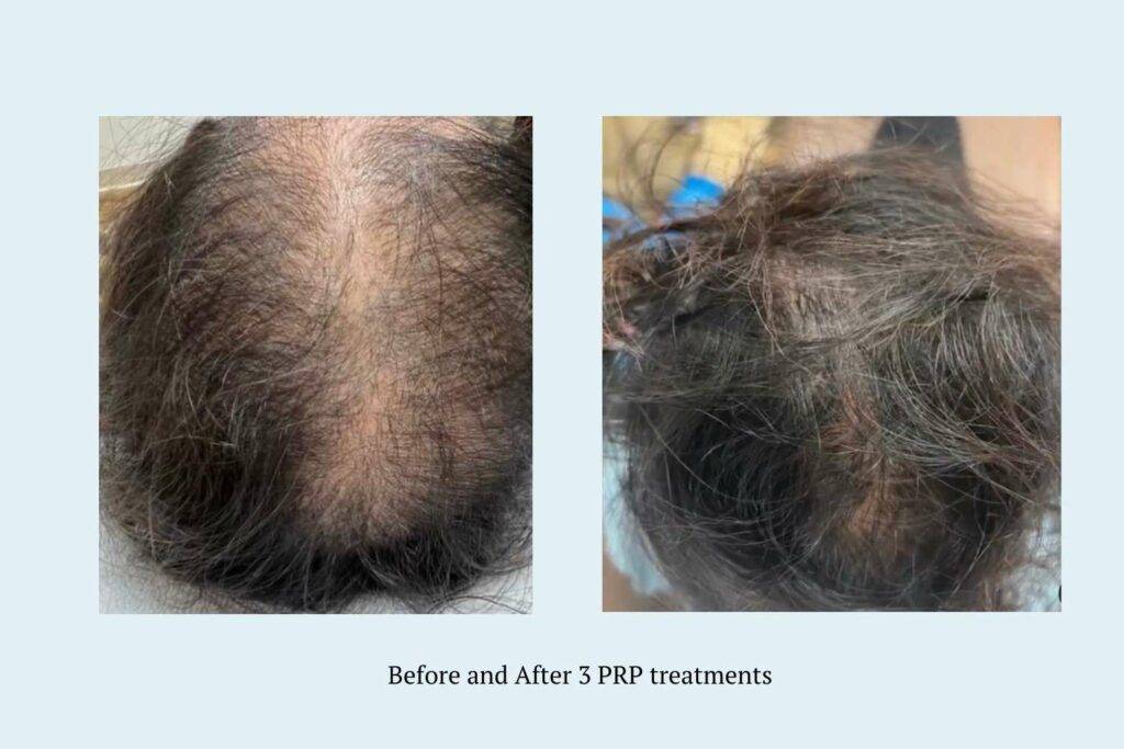 Before and after photo of woman
After 3 PRP hair restoration near me in St Petersburg, FL