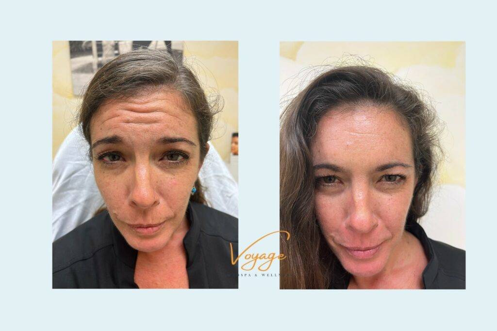 before and after botox picture
botox before and after