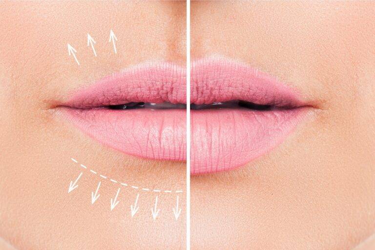 How To Get The Perfect Lips Without Fillers Med Spa Lip Flip 