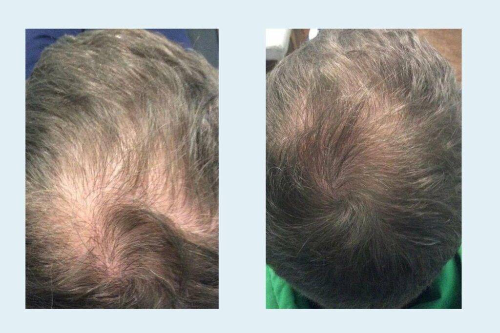 Before and after photo of man
After 4 PRP hair restoration near me in St Petersburg, FL
