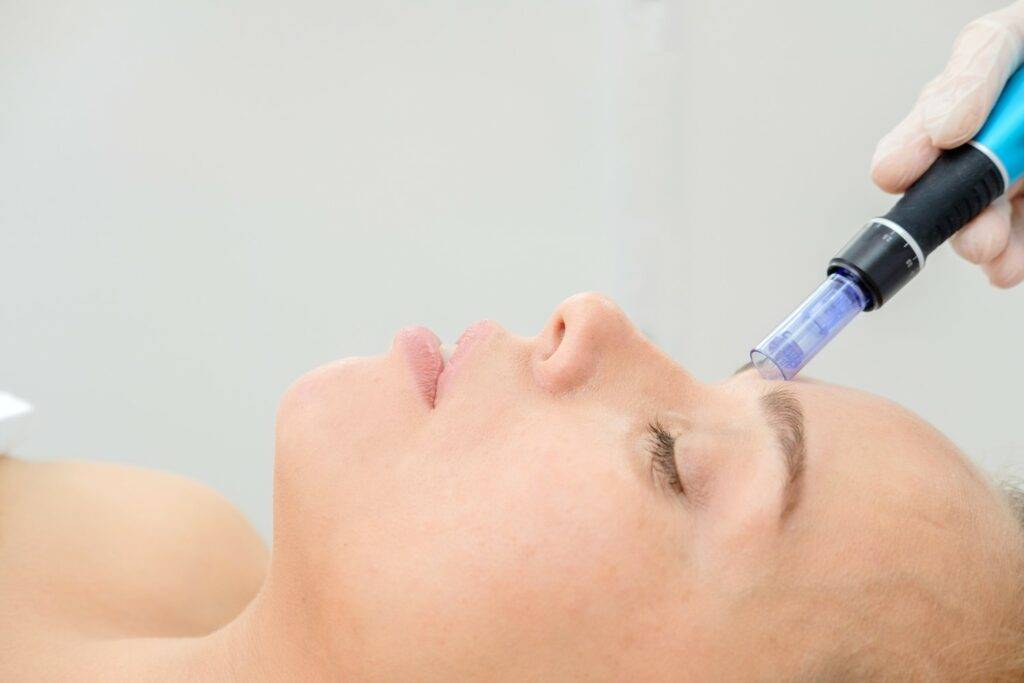 vampire microneedling near me and microneedling with prfm near me